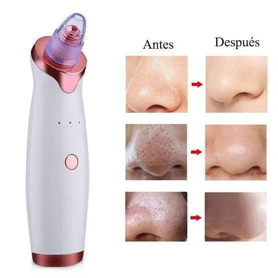 🧼 Extractor de Poros y Espinillas + 5 boquillas GRATIS 🎁